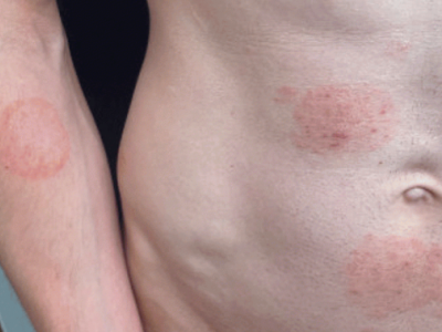 Patient with ringworm rash on torso