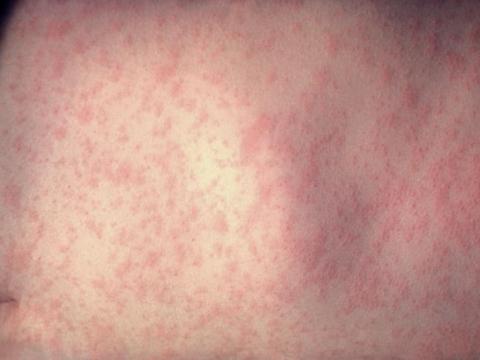 measles rash