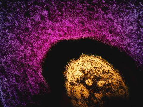 measles pic 