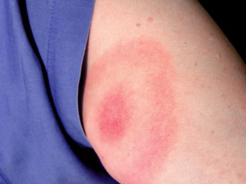 lyme disease bullseye rash