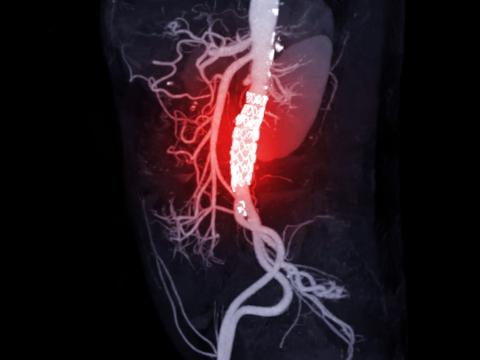 Aortic dissection