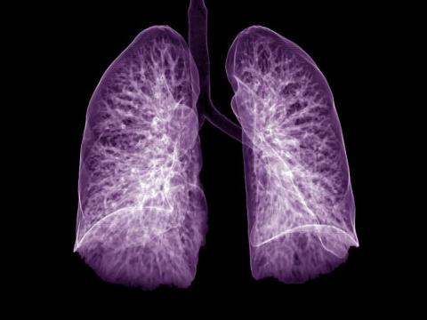 Purple lungs on x-ray