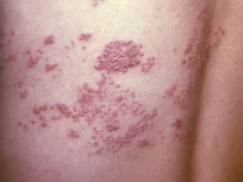 Shingles rash