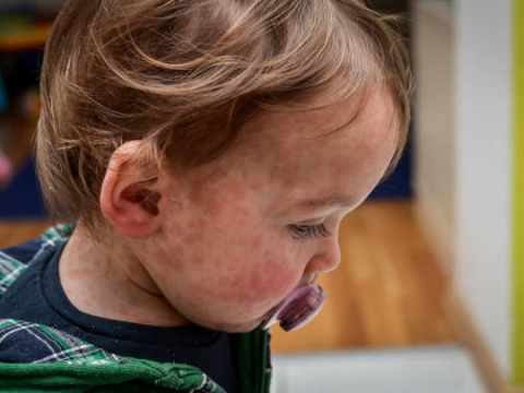 Toddler with measles