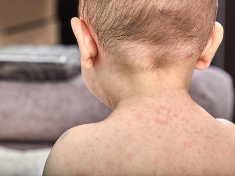 baby measles back
