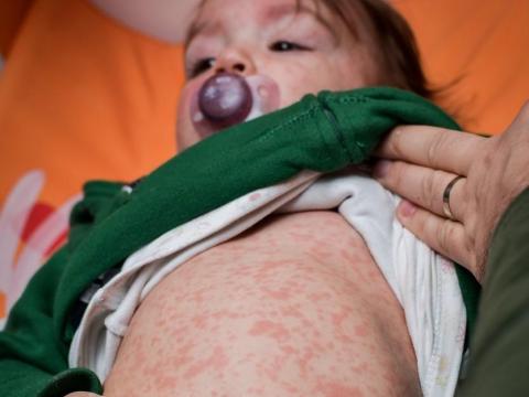 baby with measles