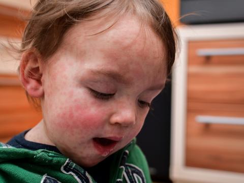 child with measles