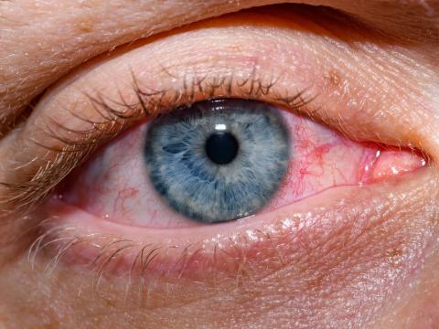 conjunctivitis