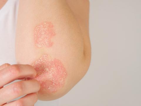 psoriasis 