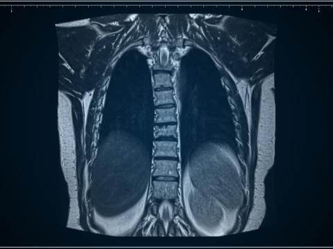 lung MRI