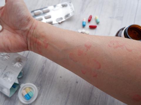 Drug-associated skin rash