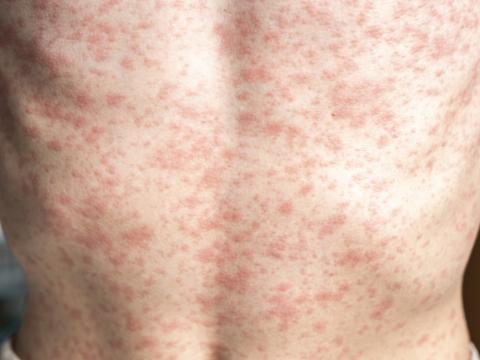 Measles rash