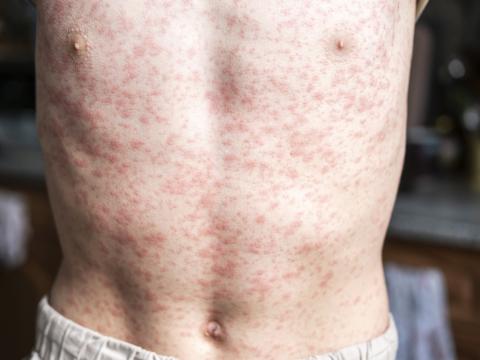 measles torso
