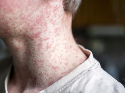 measles