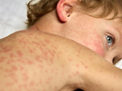 measles boy