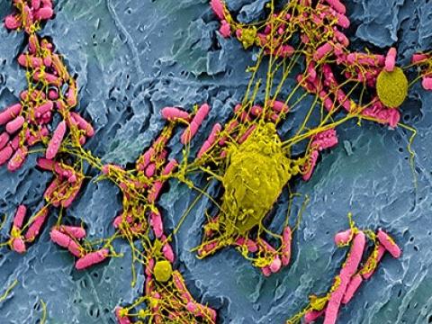 E coli bladder infection