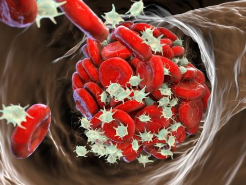 Blood clot in vein