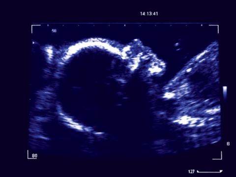 Ultrasound