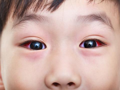 Close-up of boy with conjunctivitis