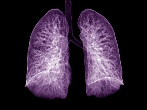 Chest CT purple lungs