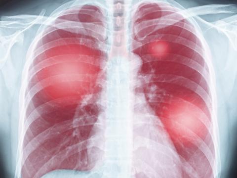 Chest x-ray with lungs shown in red