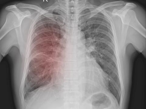 Chest x-ray