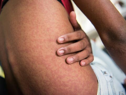 Chik skin rash