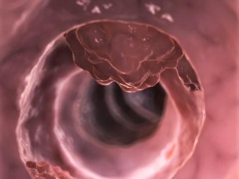 Colon cancer