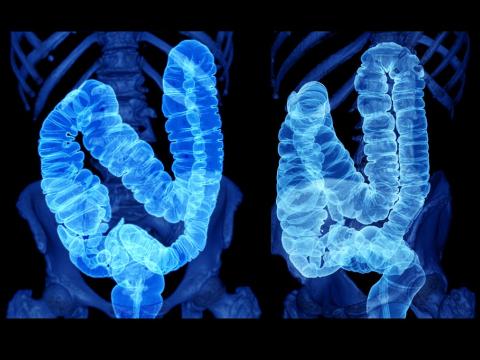 Colon imaging