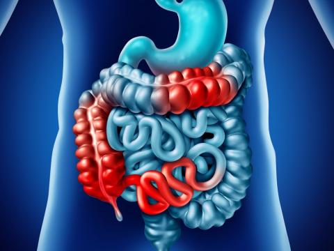 Illustration of Crohn's disease