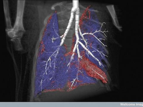 cystic fibrosis