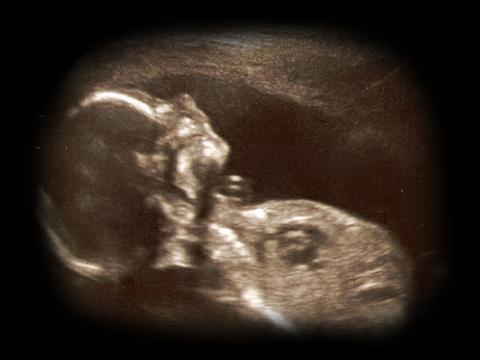 fetal ultrasound