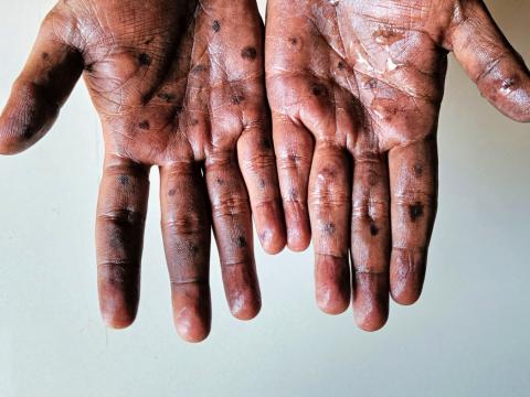 hands pox