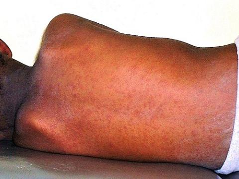 Measles in child