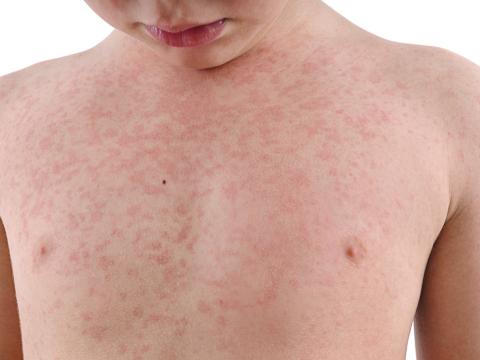 measles torso
