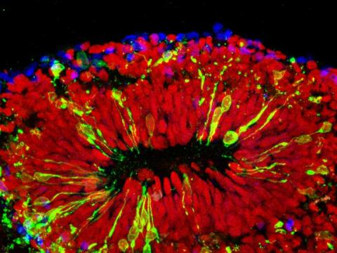 Mini brain infected with Zika