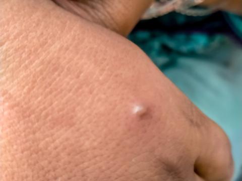 Monkeypox lesion on hand