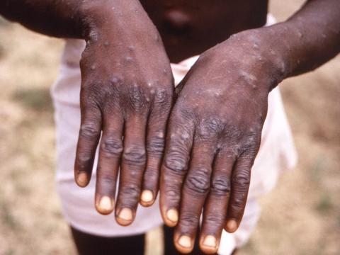 Monkeypox lesions on the back of the hands