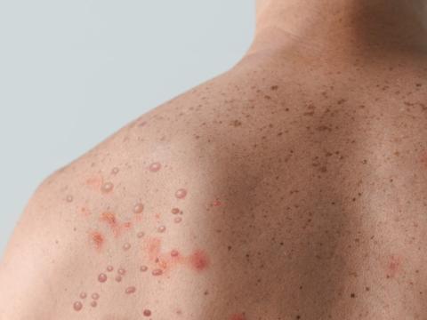 Monkeypox lesions on man's back