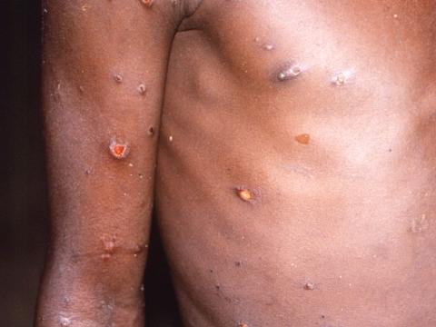 Monkeypox lesions on arm and chest