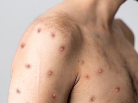 Monkeypox lesions on chest and arm