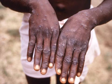 Monkeypox on back of hands