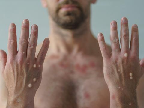 Monkeypox blisters on man's hands and chest