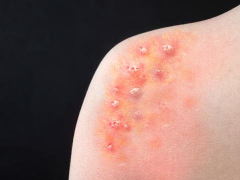 Monkeypox blisters on shoulder