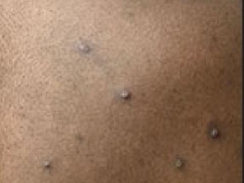 Monkeypox lesions on back and shoulder