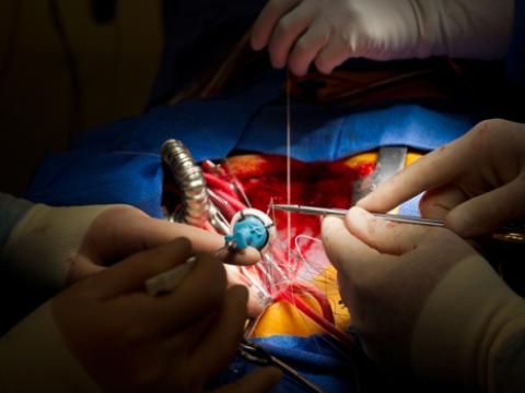 Open heart surgery