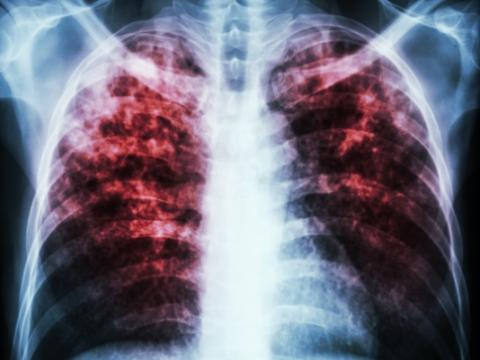 Pulmonary tuberculosis x-ray