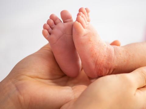 Rash on feet and ankles of baby