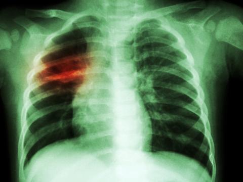 Tuberculosis chest x-ray