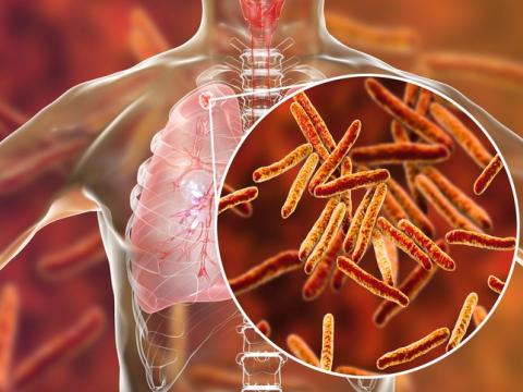 Tuberculosis in lungs